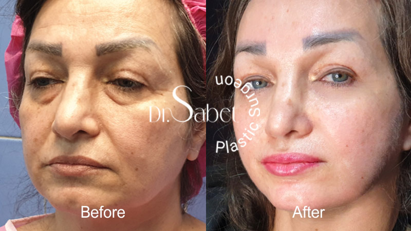جراحی زیبایی صورت برای چه سنی مناسب است؟