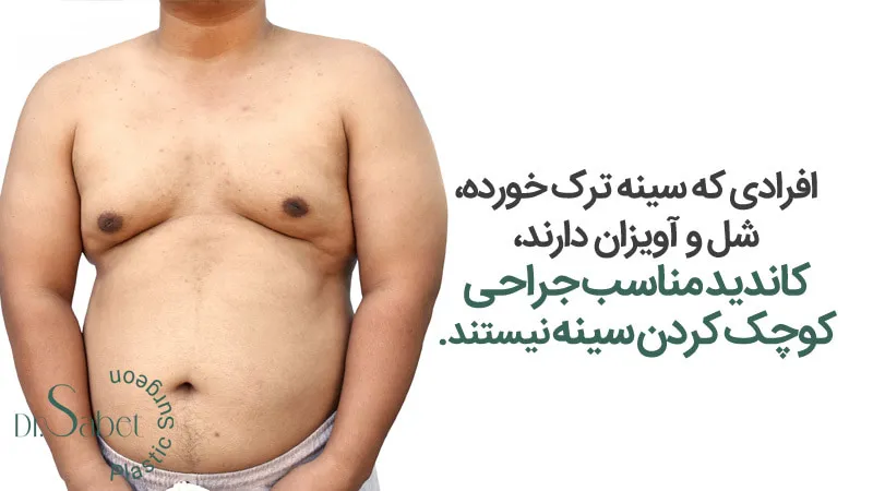 کاندیدای مناسب عمل کوچک کردن سینه