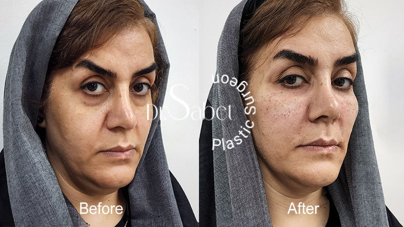 تاثیر بوتاکس بر زیبایی