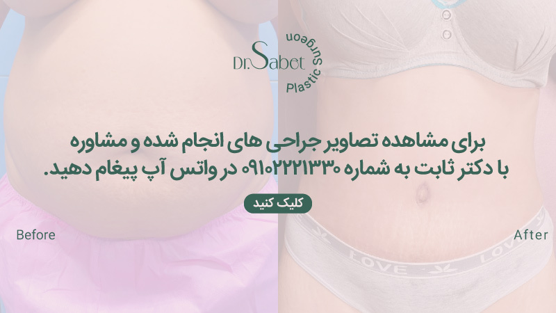 نمونه عمل لیپوماتیک