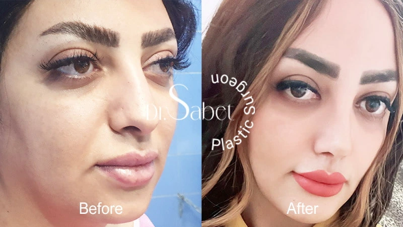 انواع روش های جراحی بینی
