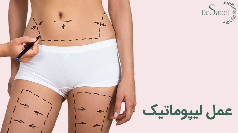 عمل لیپوماتیک