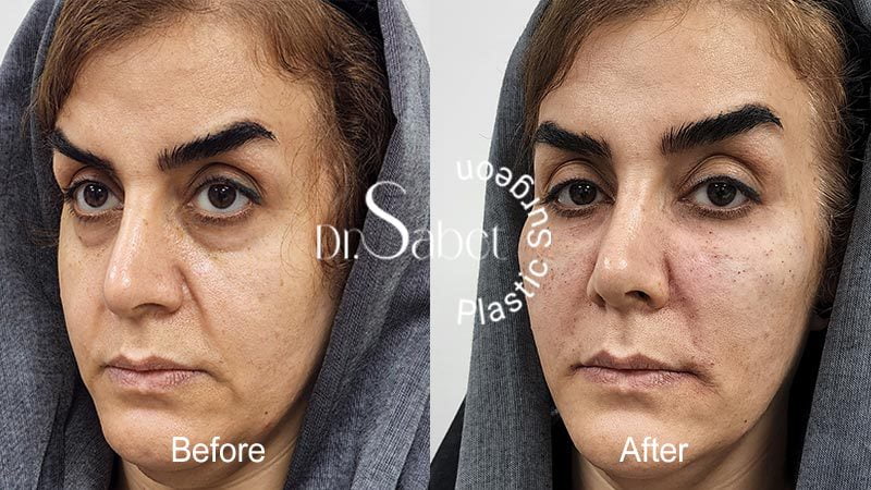 تزریق چربی صورت | تزریق چربی به صورت