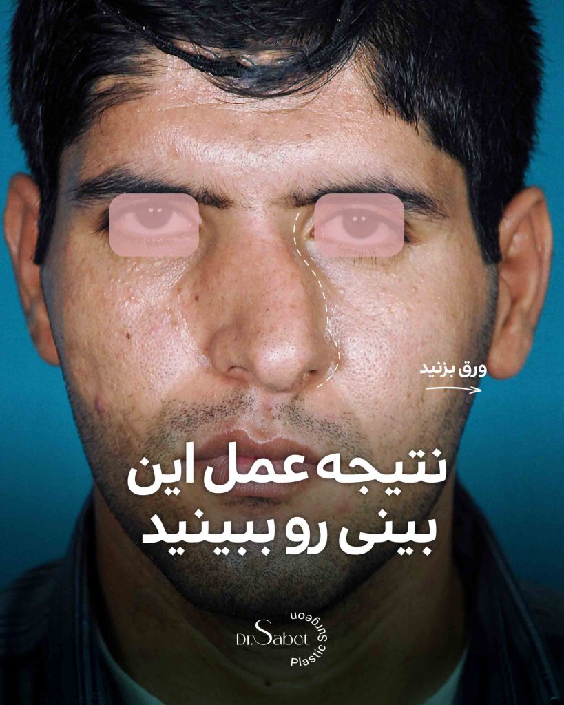 نتیجه عمل بینی مردانه | نمونه عمل انحراف بینی