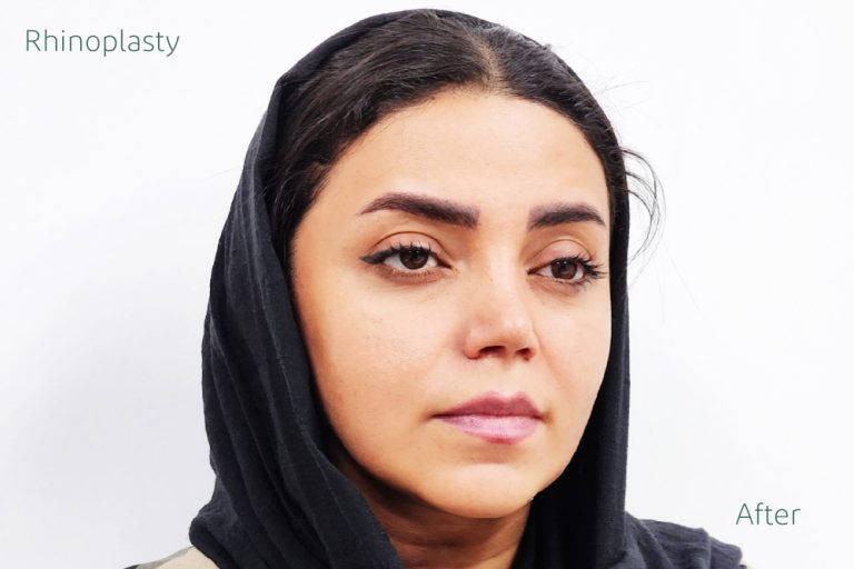 نمونه جراحی عمل بینی