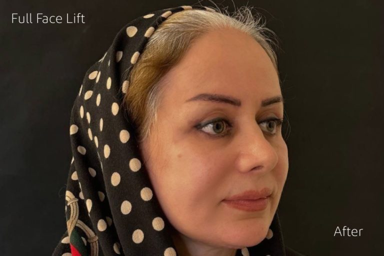 نمونه عمل لیفت کامل صورت