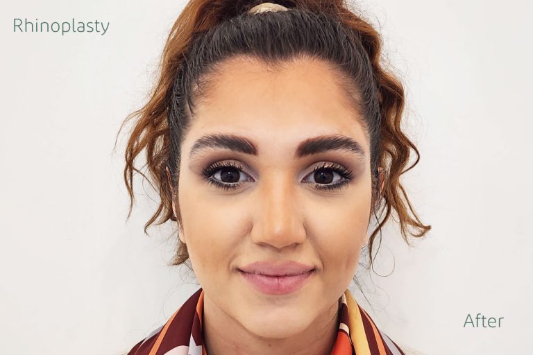 نمونه کار جراحی بینی توسط فوق تخصص جراحی پلاستیک و زیبایی