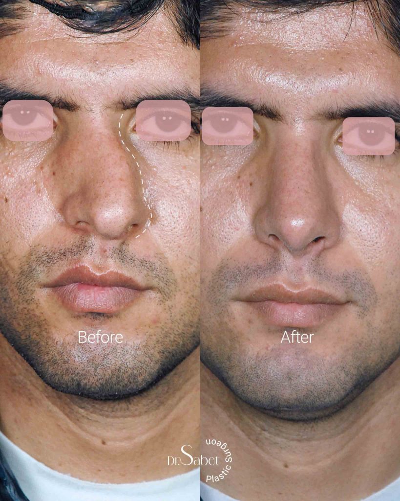 نمونه کار عمل بینی مردانه | نمونه عمل انحراف بینی