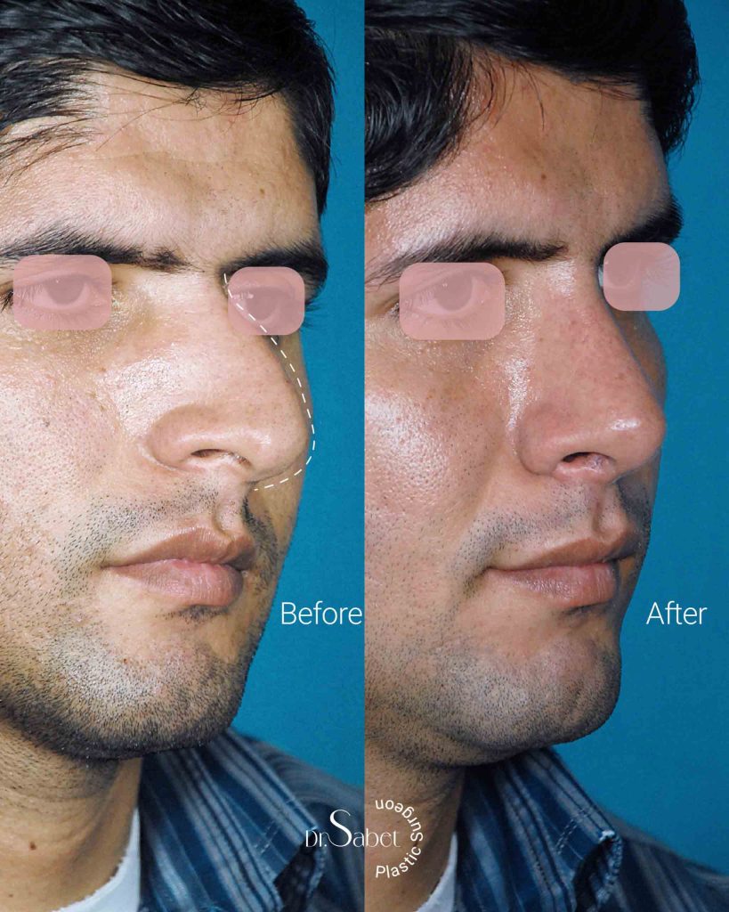 نمونه کار عمل بینی مردانه دکتر محمد ثابت