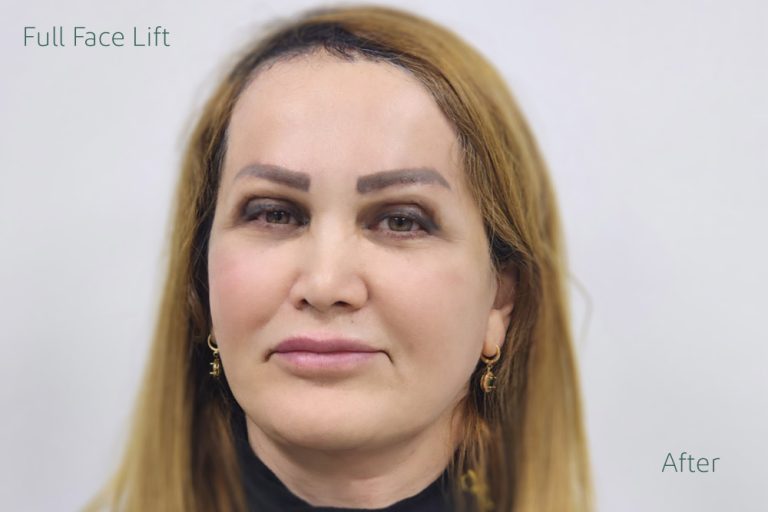 نمونه کار لیفت صورت-متخصص جراحی پلاستیک و زیبایی