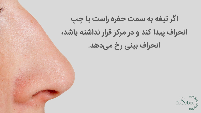 رفع انحراف بینی | اصلاح انحراف بینی