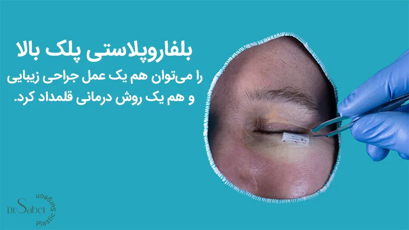 عمل بلفاروپلاستی پلک بالا چیست