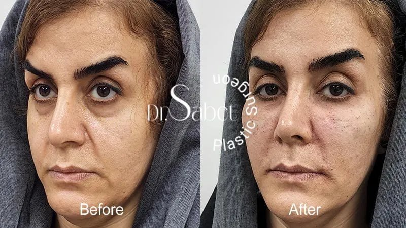 نمونه کار تزریق چربی به صورت توسط دکتر ثابت