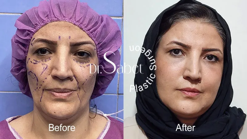 نمونه کار تزریق چربی به صورت دکتر ثابت