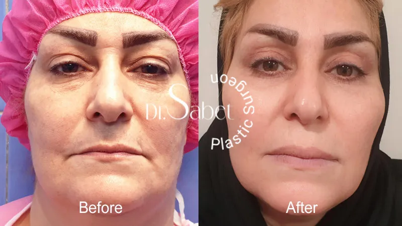 نمونه جراحی زیبایی پلک و ابرو