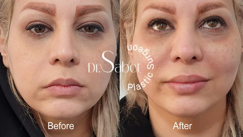 نمونه کار تزریق چربی و بوتاکس