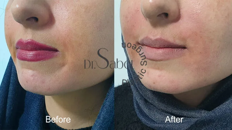 نمونه کار تزریق ژل تزریق بوتاکس
