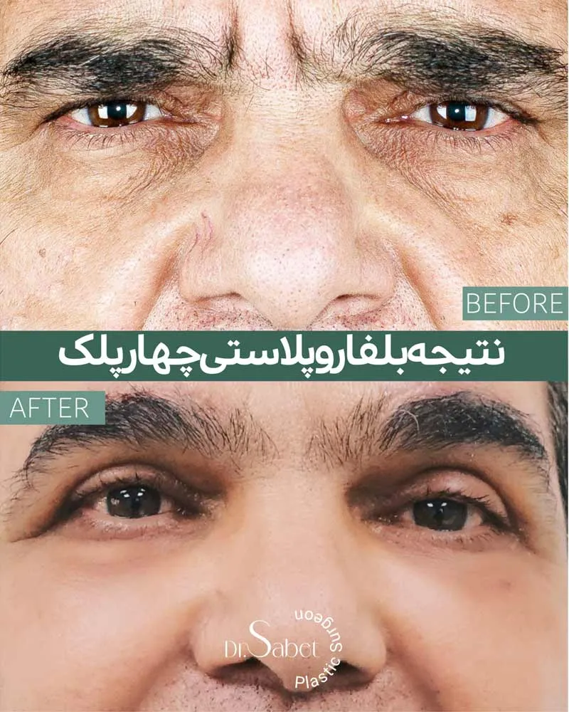 نمونه کار عمل بلفاروپلاستی چهار پلک