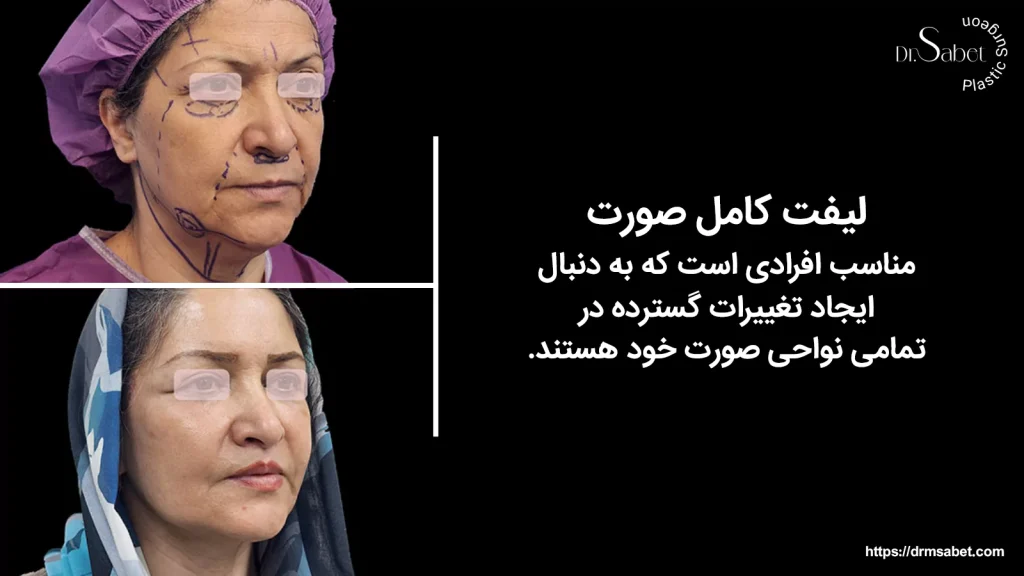 مقایسه لیفت کامل صورت