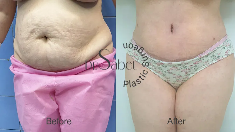 نمونه جراحی لیپوساکشن