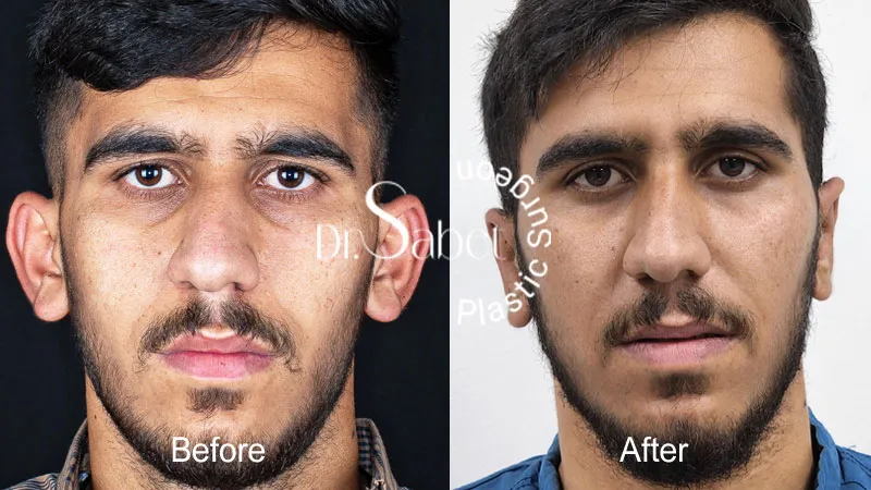 نمونه کار اتوپلاستی دکتر محمد ثابت