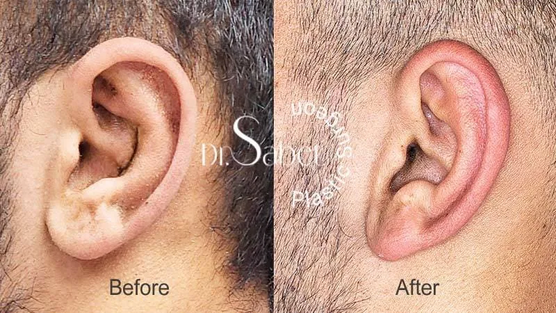 نمونه کار جراحی زیبایی گوش دکتر محمد ثابت