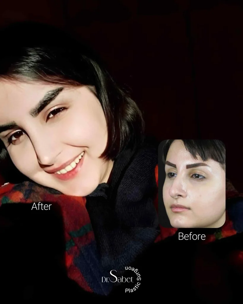 نمونه کار جراحی بینی طبیعی دکتر محمد ثابت