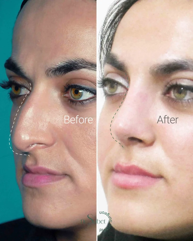 نمونه کار عمل جراحی بینی طبیعی دکتر محمد ثابت