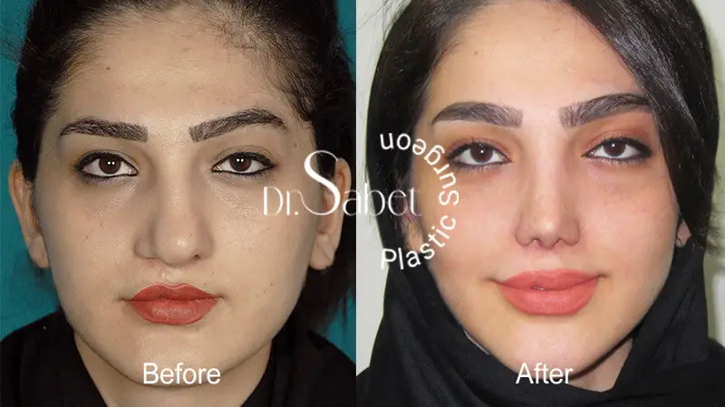 نمونه کار عمل جراحی زیبایی بینی دکتر محمد ثابت